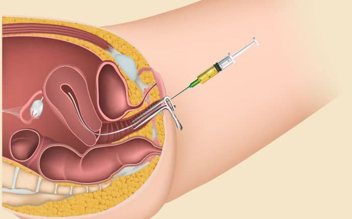 Do and Do Not After an IUI Procedure