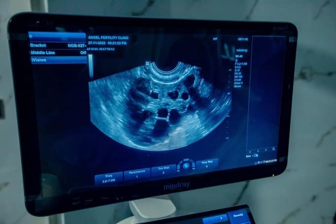 Monitoring screen at Angel Fertility Clinic